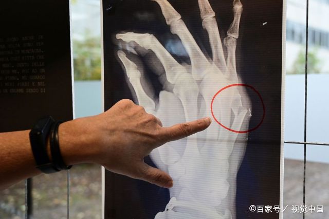 图为一名受害者手掌骨折.